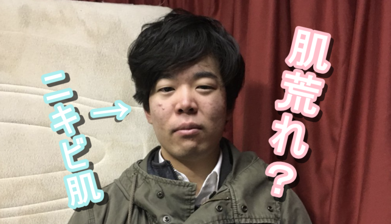 ニキビ 芦田 愛菜